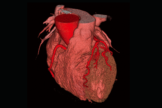 心臟計算機輔助檢測系統(cardiocad)是一款專門用於冠脈cta圖像分析的